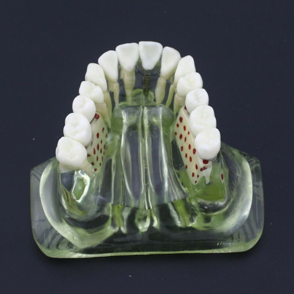 Dentist Student Tool Dental Model Upper Jaw With Crown Bridge