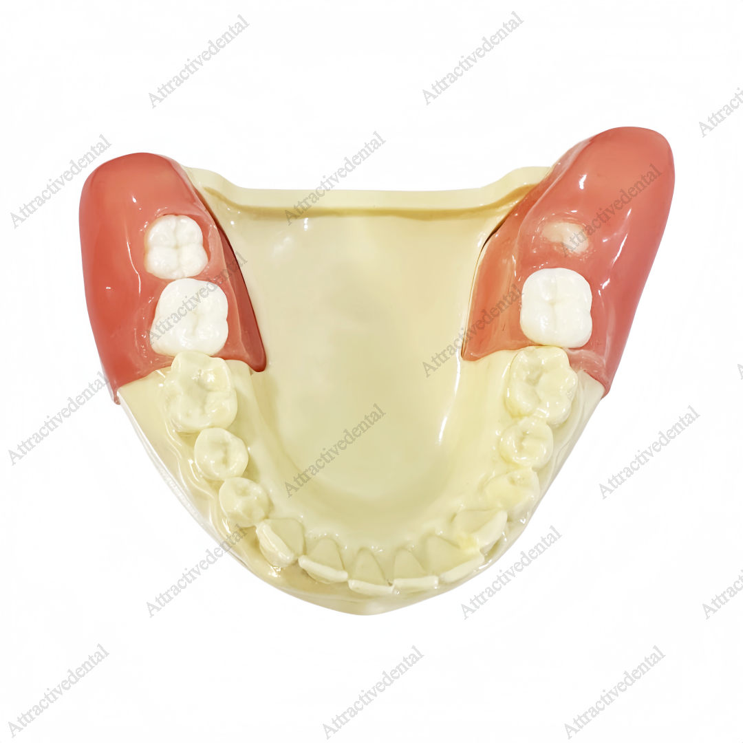 Dental Obstructed Wisdom Teeth Extraction Model Lower Soft Gingiva Study Model
