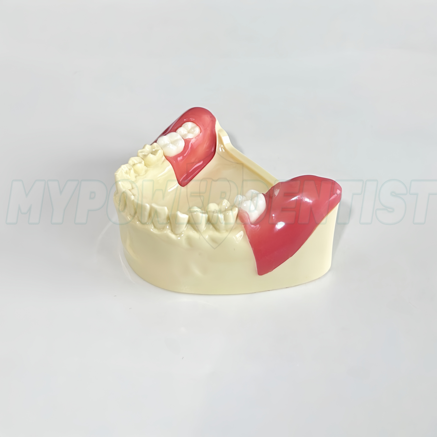 Dental Obstructed Wisdom Teeth Extraction Model Lower Soft Gingiva Wisdom Model
