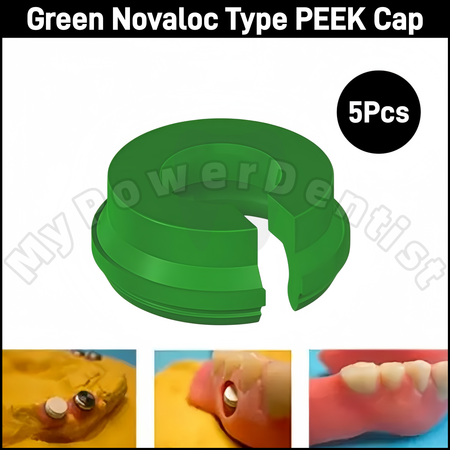 Dental PEEK Cap Abutment Titanium Housing Cap Retention Insert Caps Novaloc Type