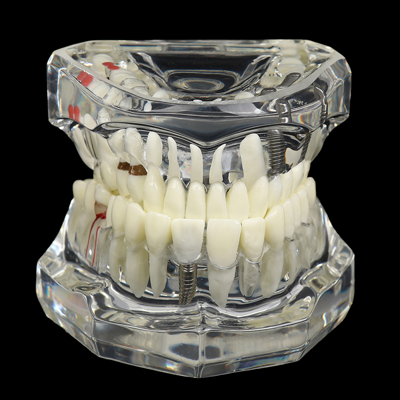 Dental Disease Model Teeth Teach Study Oral Teeth Bridge Restoration Pathology